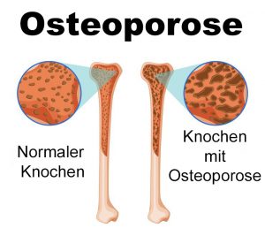 Osteoporose-Ernährungsberatung